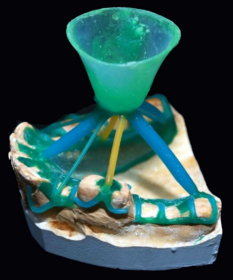 revolutionizing-rehabilitation-prosthodontic-management-of-distal